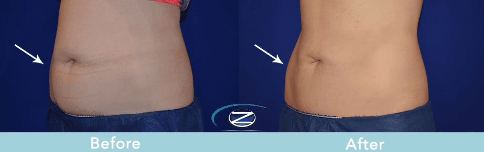 Coolsculpting Abdomen Before & After #3 - Zcosmetic Health