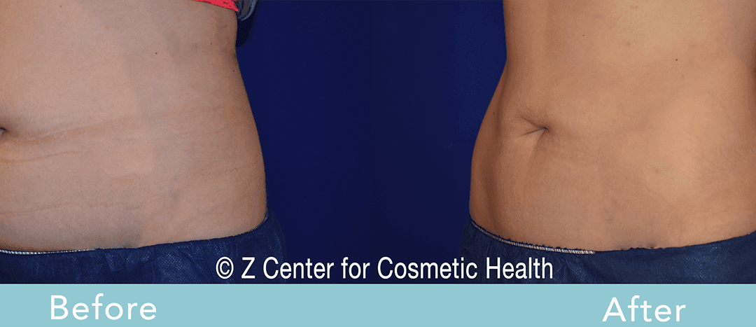 Coolsculpting Abdomen Before & After #19 - Zcosmetic Health