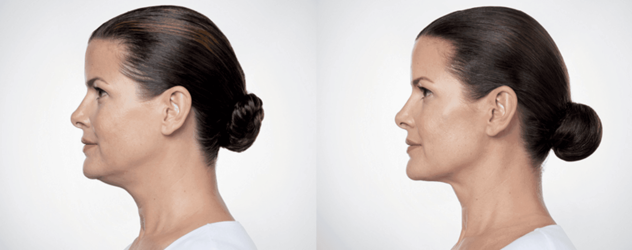 what is kybella