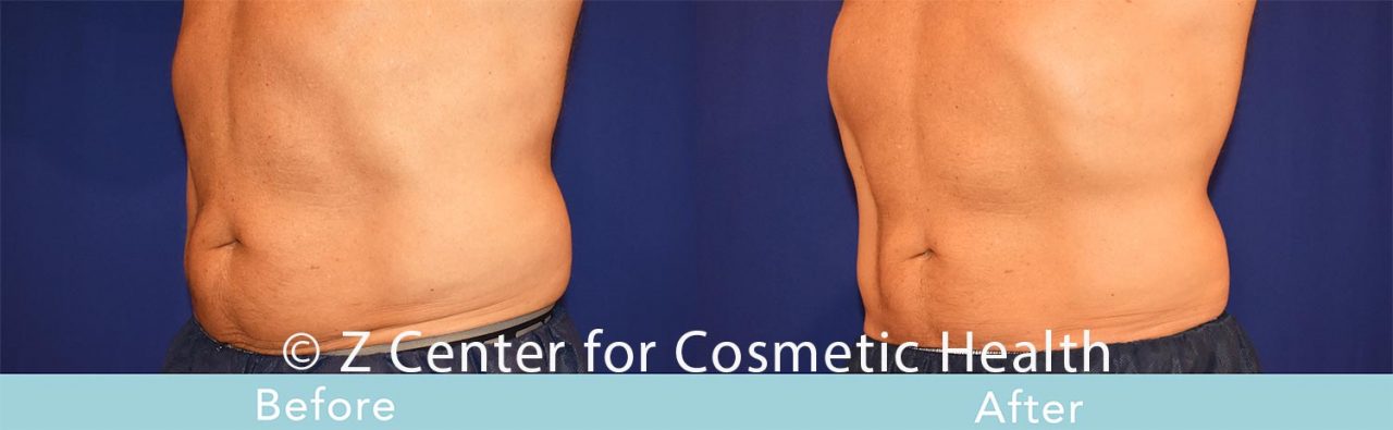 Coolsculpting Archives - Page 5 Of 16 - Zcosmetic Health