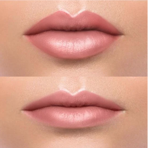 Lip fillers before and after being dissolved