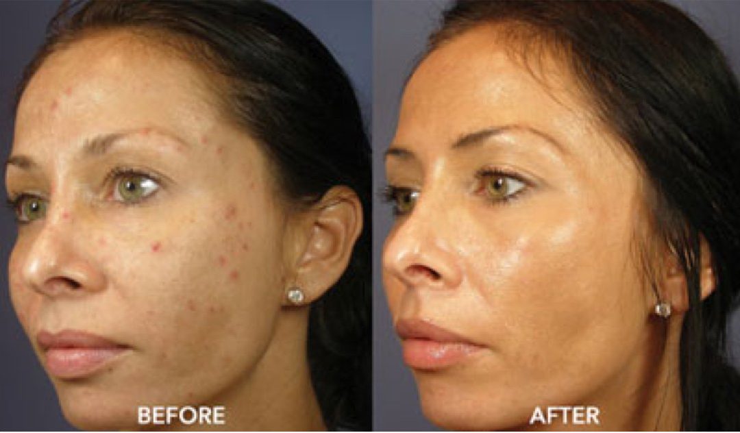 VI Peel for Acne Scars